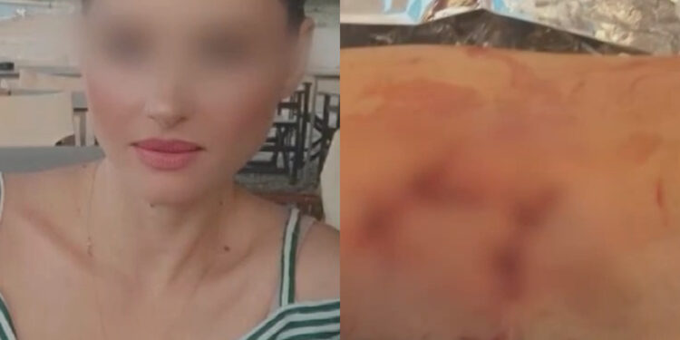 Alldaynews.gr Σε κατάσταση σοκ νοσηλεύεται η 34χρονη: «Με κατασπάραξαν – Με δάγκωσαν παντού, έχω μώλωπες και ράμματα»