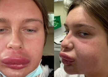 “Το πpήξιμο δεν υποχωρούσε ποτέ”: 23χρονη πήγε σε κλινική να διορθώσει τα χείλη της, αλλά βγήκε.. Ντόναλντ Ντακ