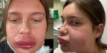 Alldaynews.gr “Το πpήξιμο δεν υποχωρούσε ποτέ”: 23χρονη πήγε σε κλινική να διορθώσει τα χείλη της, αλλά βγήκε.. Ντόναλντ Ντακ