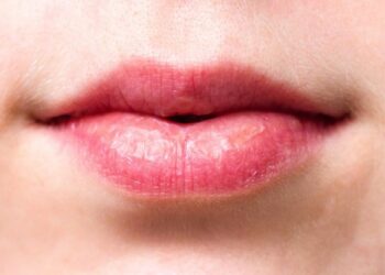 Προσοχή! Αν τα χείλη σας γίνουν έτσι κάντε άμεσα εξετάσεις για καρδιά