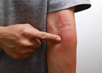 Αν προσέξετε ένα τέτοιο σημάδι στο δέρμα, κάντε εξετάσεις για καρκίνο στο πάγκρεας