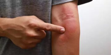 Alldaynews.gr Αν προσέξετε ένα τέτοιο σημάδι στο δέρμα, κάντε εξετάσεις για καρκίνο στο πάγκρεας