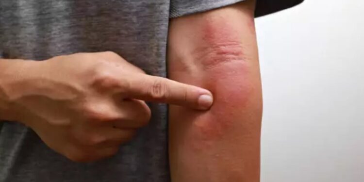 Alldaynews.gr Αν προσέξετε ένα τέτοιο σημάδι στο δέρμα, κάντε εξετάσεις για καρκίνο στο πάγκρεας