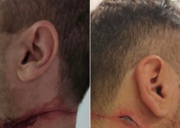 Θεσσαλονίκη: Σοκάρουν οι εικόνες με τα τραύματα των αστυνομικών που δέχτηκαν επίθεση από αλλοδαπό