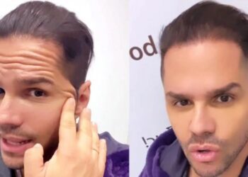 Παραμορφώθηκε ο Γιώργος Τσαλίκης μετά το μπότοξ που έκανε – «Το μέτωπό μου δεν κουνιέται»