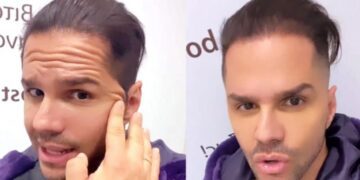 Alldaynews.gr Παραμορφώθηκε ο Γιώργος Τσαλίκης μετά το μπότοξ που έκανε – «Το μέτωπό μου δεν κουνιέται»