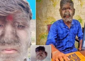 Alldaynews.gr Ο «λυκάνθρωπος της Ινδίας» δεν το βάζει κάτω παρά το bullying που έχει υποστεί: «Μου πετούσαν πέτρες όταν ήμουν μικρός»