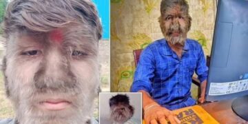 Alldaynews.gr Ο «λυκάνθρωπος της Ινδίας» δεν το βάζει κάτω παρά το bullying που έχει υποστεί: «Μου πετούσαν πέτρες όταν ήμουν μικρός»