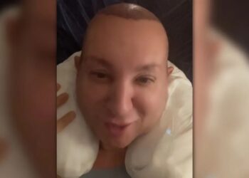 Βασίλειος Κωστέτσος: Το βίντεο μετά την εμφύτευση μαλλιών – «Έχω γίνει φουσκομαγουλίτσα»