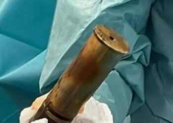 Έγινε και αυτό! 88χρονος πήγε στα επείγοντα με οβίδα του Α’ Παγκοσμίου στον πρωκτ0 του