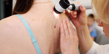 Alldaynews.gr Ελπίδες δίνει εμβόλιο των Moderna και Merck κατά του καρκίνου του δέρματος – Μειώνει κατά 44% τον κίνδυνο υποτροπής ή θανάτου