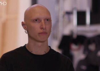 MasterChef: Η συγκινητική ιστορία του παίκτη με την αλωπεκία: «Τα μισά μαλλιά μου ήταν στο κρεβάτι»