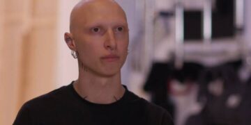 Alldaynews.gr MasterChef: Η συγκινητική ιστορία του παίκτη με την αλωπεκία: «Τα μισά μαλλιά μου ήταν στο κρεβάτι»