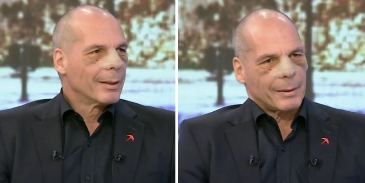 Alldaynews.gr Η πρώτη εμφάνιση του Βαρουφάκη με σπασμένη μύτη μετά την επίθεση στα Εξάρχεια και η απαίτηση της συζύγου του (video)