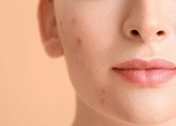 Πώς να αφαιρέσετε τα σημάδια ακμής;