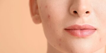 Alldaynews.gr Πώς να αφαιρέσετε τα σημάδια ακμής;