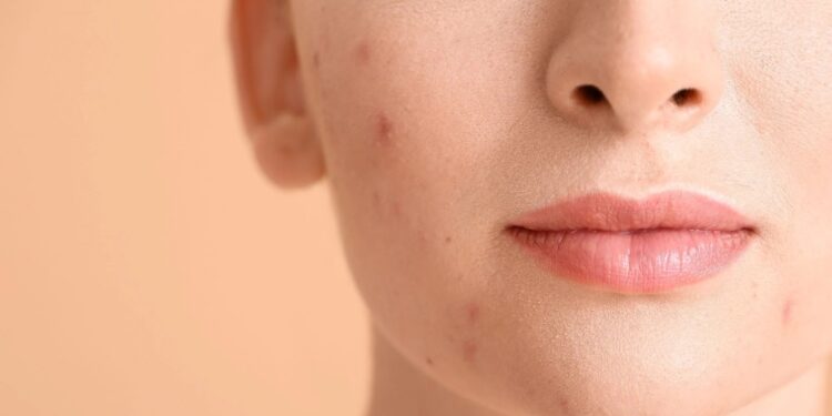 Alldaynews.gr Πώς να αφαιρέσετε τα σημάδια ακμής;