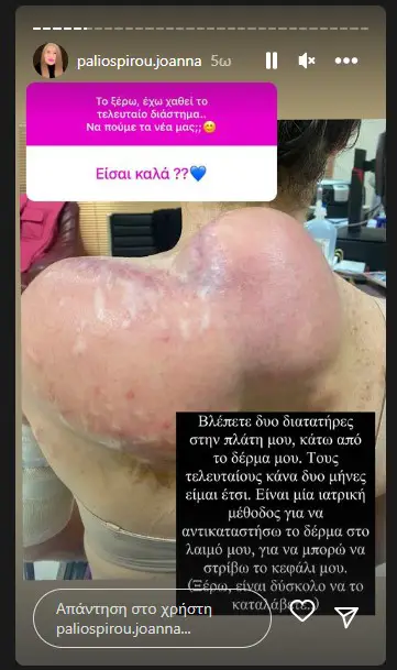 Σοκάρει η νέα φωτογραφία της Ιωάννας Παλιοσπύρου για τις θεραπείες της – «Όποιος είναι ευαίσθητος να κάνει skip»