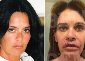 Ελληνίδα συγγραφέας είδε τα χείλη της να «σαπίζουν» μετά από πλαστική επέμβαση