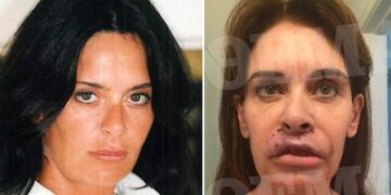 Alldaynews.gr Ελληνίδα συγγραφέας είδε τα χείλη της να «σαπίζουν» μετά από πλαστική επέμβαση