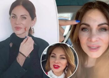 Έκανε μπότοξ στο πρόσωπο για 20 χρόνια και δείχνει πώς είναι τώρα που σταμάτησε