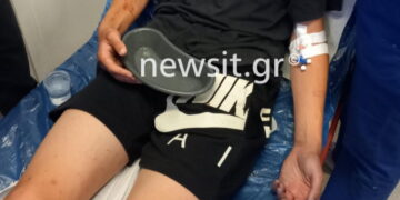 Alldaynews.gr Άγριος ξυλοδαρμός 16χρονου από ανηλίκους στην Καλαμάτα! Εικόνες ντοκουμέντα από τα τραύματα του