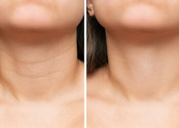 Ρυτίδες λαιμού: 7 συμβουλές για να τις μειώσετε