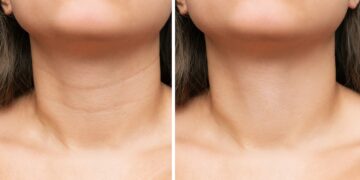 Ρυτίδες λαιμού: 7 συμβουλές για να τις μειώσετε