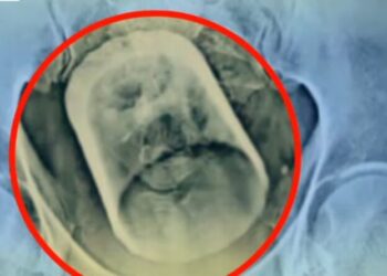 Άντρας βρέθηκε με γυάλινο ποτήρι στο έντερο: «Έπινα τσάι και το κατάπια, είπε στον γιατρό»