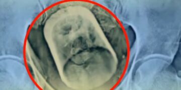 Alldaynews.gr Άντρας βρέθηκε με γυάλινο ποτήρι στο έντερο: «Έπινα τσάι και το κατάπια, είπε στον γιατρό»