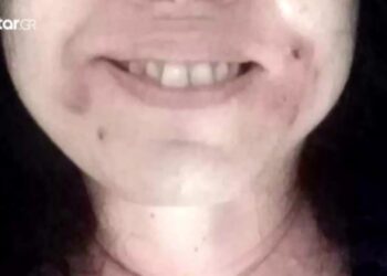 Alldaynews.gr «Γέμισα κύστες, παραμορφώθηκα!» – Σοκάρει θύμα για τα παράνομα botox σε γνωστά ιατρεία (φωτο, video)