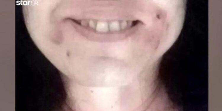 «Γέμισα κύστες, παραμορφώθηκα!» – Σοκάρει θύμα για τα παράνομα botox σε γνωστά ιατρεία (φωτο, video)