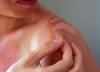 Ηλιακό έγκαυμα: Γιατί δεν πρέπει να «τραβάμε» το δέρμα που ξεφλουδίζει