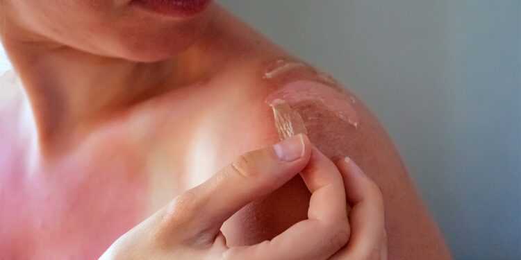 Alldaynews.gr Ηλιακό έγκαυμα: Γιατί δεν πρέπει να «τραβάμε» το δέρμα που ξεφλουδίζει