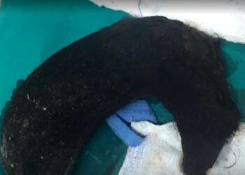 Σοk στη Θεσσαλονίκη: Αυτό έβγαλαν από το στομάχι της 14χρονης-Πως ανακάλυψαν οτι έτρωγε τρίχες[Φωτογραφίες]