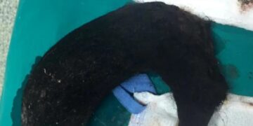 Σοk στη Θεσσαλονίκη: Αυτό έβγαλαν από το στομάχι της 14χρονης-Πως ανακάλυψαν οτι έτρωγε τρίχες[Φωτογραφίες]