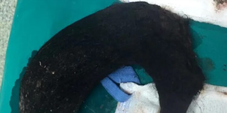 Σοk στη Θεσσαλονίκη: Αυτό έβγαλαν από το στομάχι της 14χρονης-Πως ανακάλυψαν οτι έτρωγε τρίχες[Φωτογραφίες]