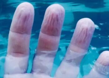 Γιατί μουλιάζουν τα χέρια όταν μένουμε πολλή ώρα στο νερό – Πότε να ανησυχήσετε