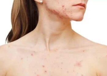 Συναγερμός για την ιλαρά στο Λονδίνο: Κίνδυνος για επιδημία με χιλιάδες περιστατικά