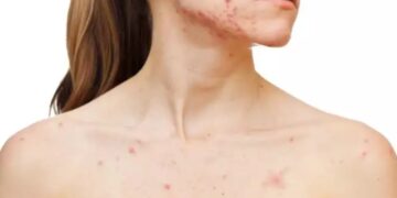 Alldaynews.gr Συναγερμός για την ιλαρά στο Λονδίνο: Κίνδυνος για επιδημία με χιλιάδες περιστατικά