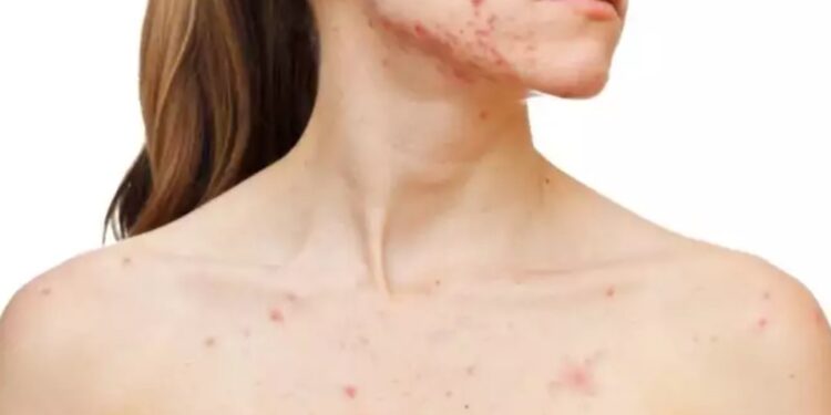 Alldaynews.gr Συναγερμός για την ιλαρά στο Λονδίνο: Κίνδυνος για επιδημία με χιλιάδες περιστατικά