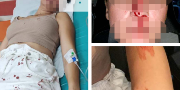 Alldaynews.gr «Έπεσε, τι δεν καταλαβαίνετε»: Σοκάρουν τα τραύματα της 30χρονης – Δεν εμφανίστηκε ο διεθνής αθλητής (φωτο)