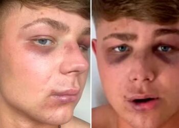 Ζάκυνθος: «Με έστειλαν στο νοσοκομείο για μία selfie», λέει ο Βρετανός τουρίστας που ξυλοκοπήθηκε από μπράβους