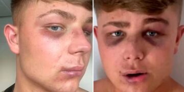 Ζάκυνθος: «Με έστειλαν στο νοσοκομείο για μία selfie», λέει ο Βρετανός τουρίστας που ξυλοκοπήθηκε από μπράβους