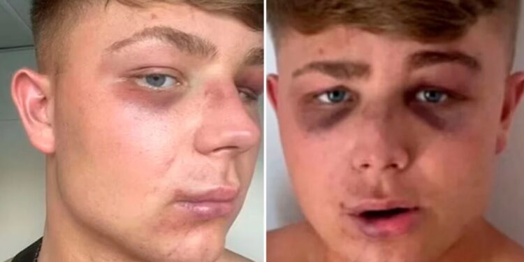 Ζάκυνθος: «Με έστειλαν στο νοσοκομείο για μία selfie», λέει ο Βρετανός τουρίστας που ξυλοκοπήθηκε από μπράβους