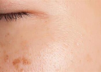 Πανάδες: Tι είναι και πώς να απαλλαγείς