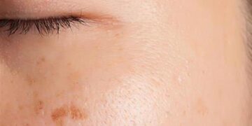 Πανάδες: Tι είναι και πώς να απαλλαγείς