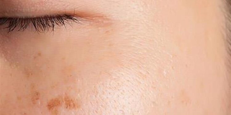 Πανάδες: Tι είναι και πώς να απαλλαγείς