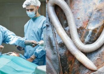 Άφωνοι οι Γιατροί! Βρήκαν ζωντανό σκοuλήκι στον εγκέφαλο γυναίκας, για πρώτη φορά παγκοσμίως[Φωτογραφίες]