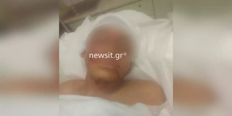 Επίθεση πίτμπουλ σε 11χρονο στην Αρτέμιδα: «Πρόκειται για απόπειρα δολοφονίας του παιδιού!»